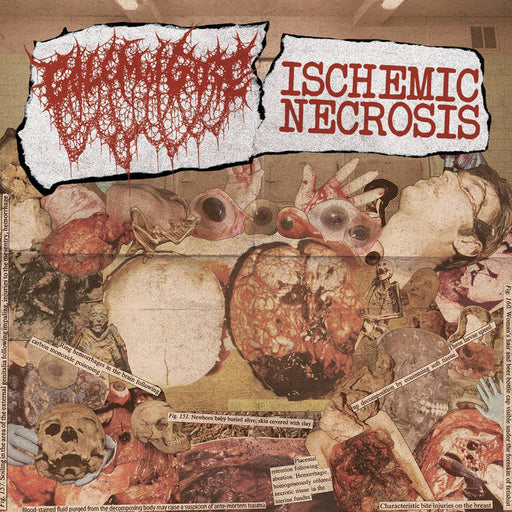 Ischemic Necrosis / Golem of Gore - Split